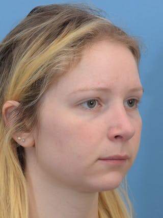 Rhinoplasty Before & After Gallery - Patient 544407 - Image 6
