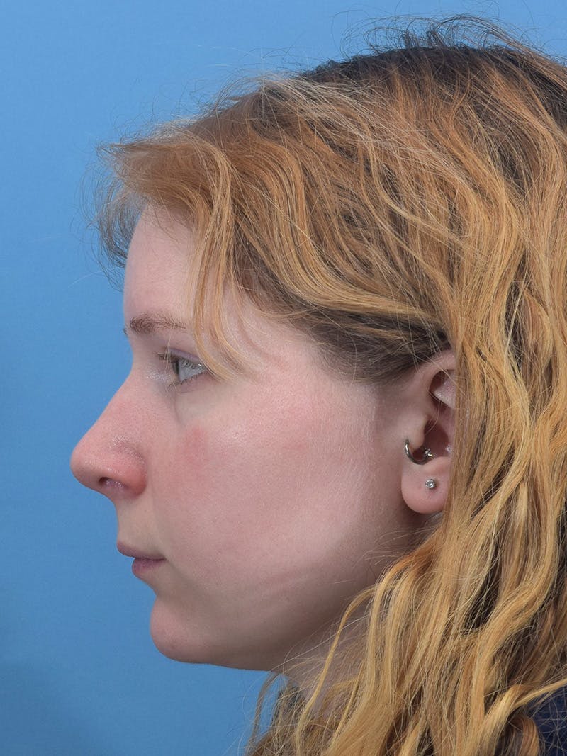 Rhinoplasty Before & After Gallery - Patient 544407 - Image 1