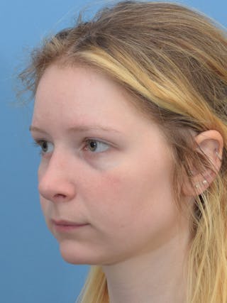 Rhinoplasty Before & After Gallery - Patient 544407 - Image 10