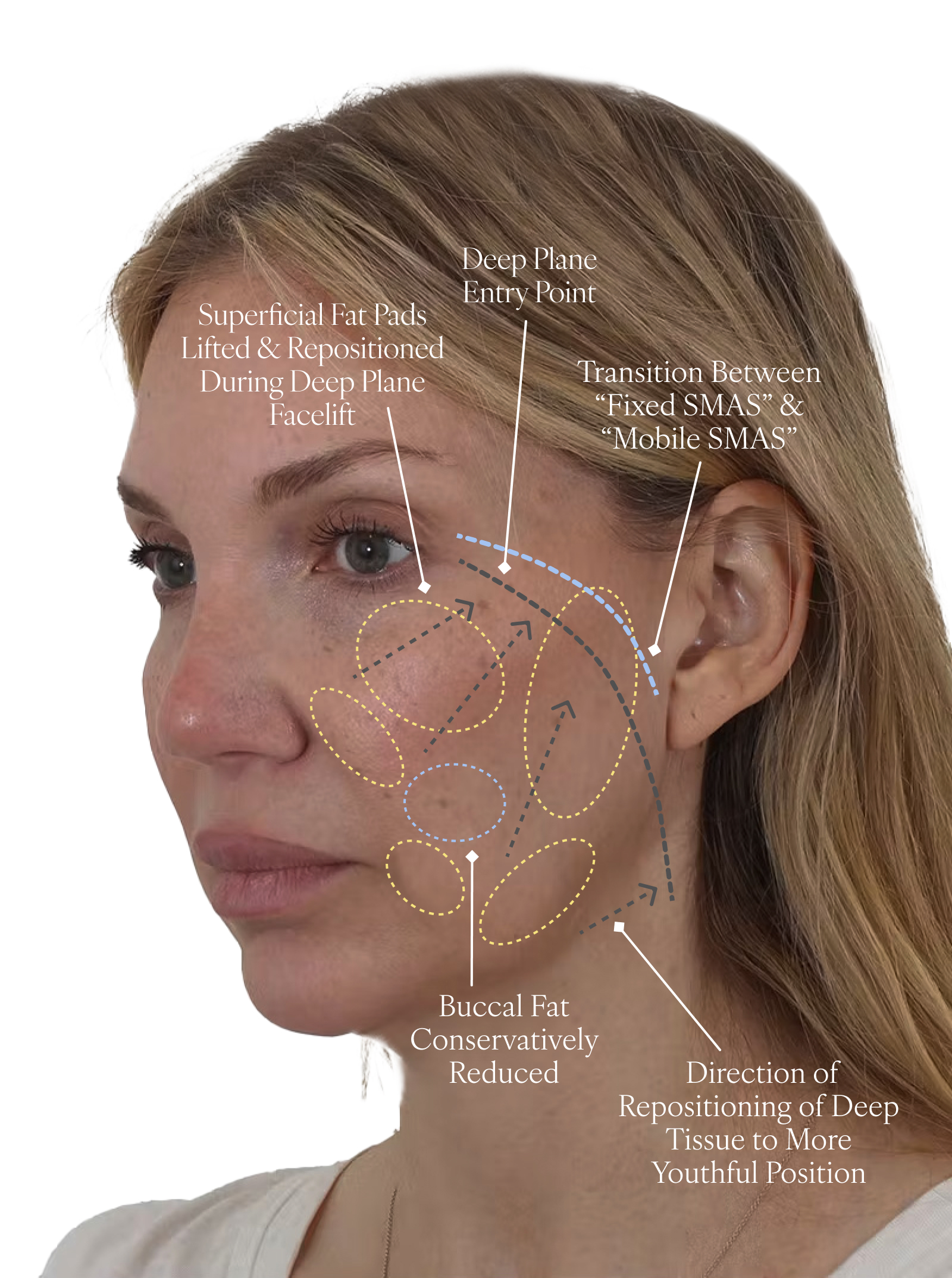 deep plane facelift illustration