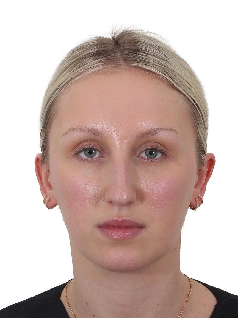 Rhinoplasty Before & After Gallery - Patient 199292 - Image 5