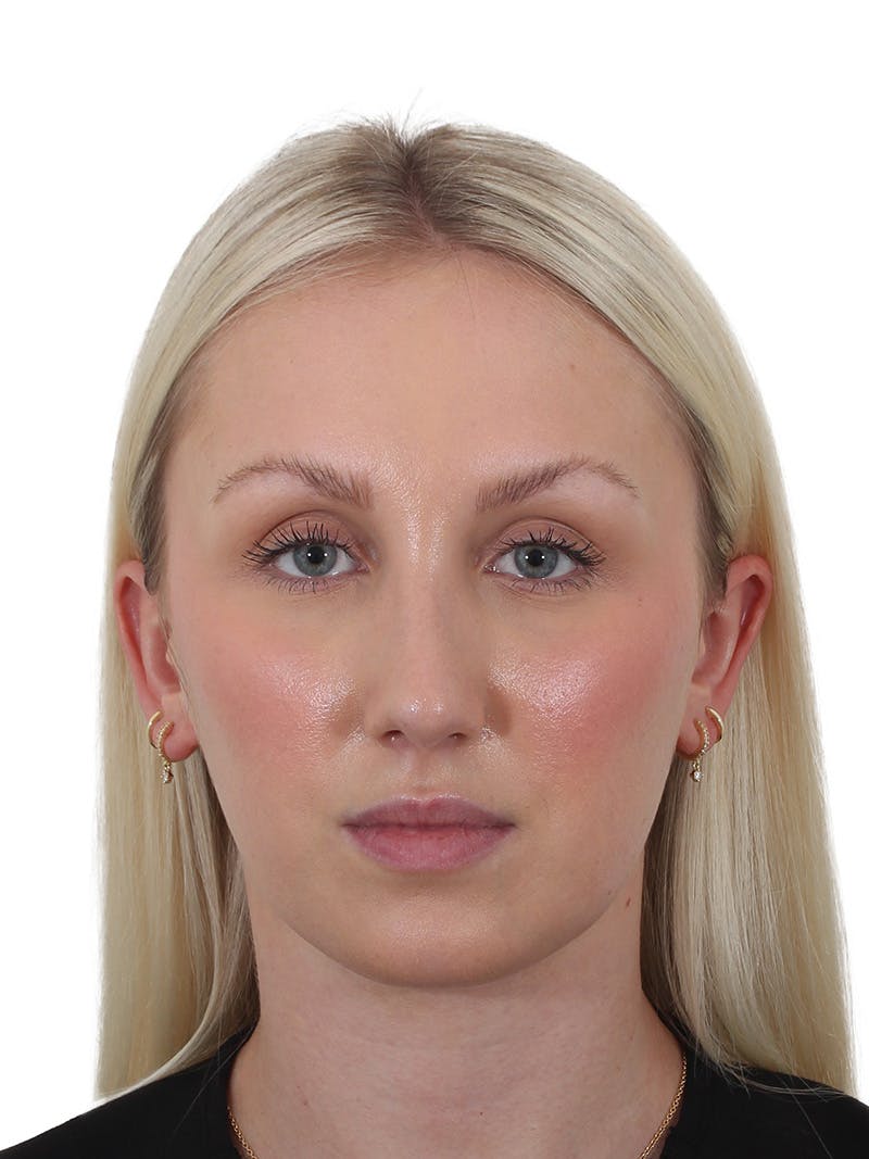 Rhinoplasty Before & After Gallery - Patient 199292 - Image 6