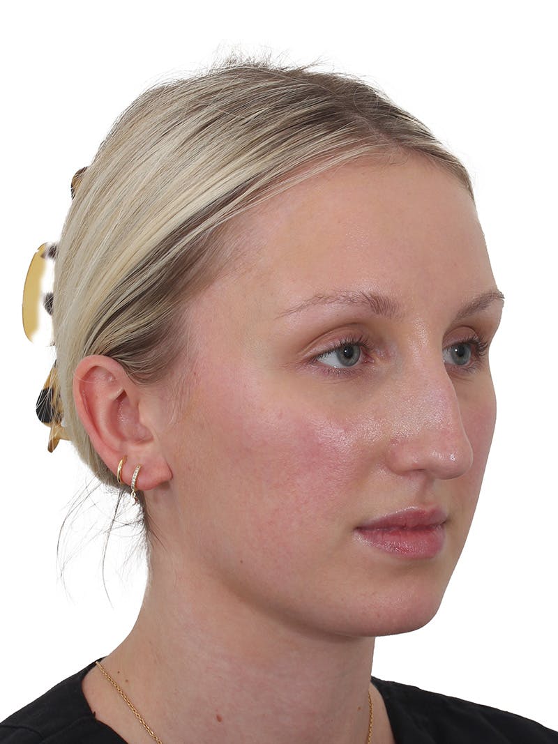 Rhinoplasty Before & After Gallery - Patient 199292 - Image 7