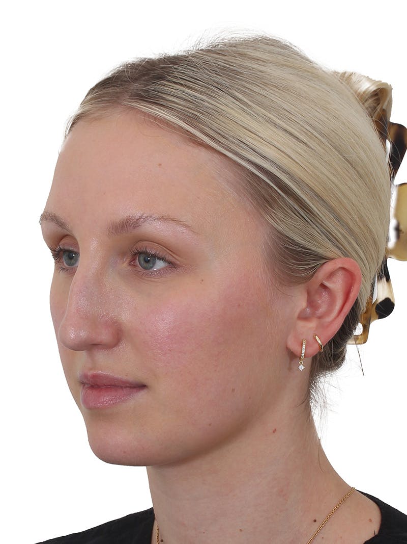 Rhinoplasty Before & After Gallery - Patient 199292 - Image 9