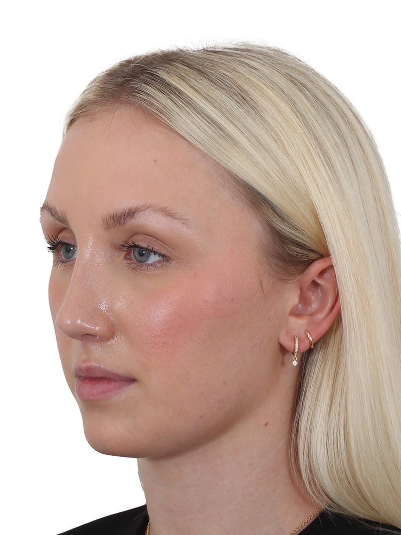 Rhinoplasty Before & After Gallery - Patient 199292 - Image 10