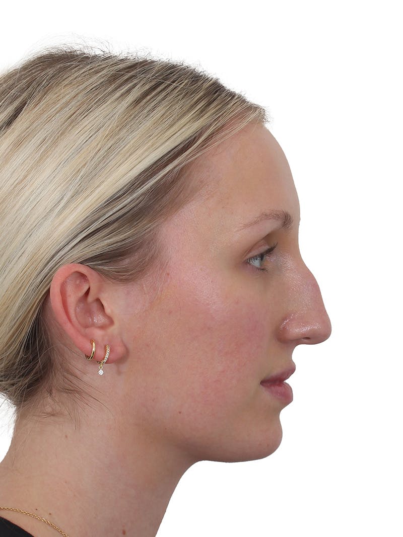 Rhinoplasty Before & After Gallery - Patient 199292 - Image 11