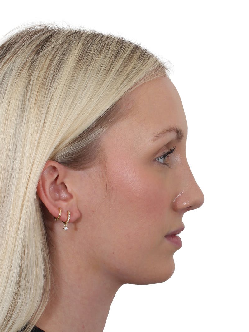 Rhinoplasty Before & After Gallery - Patient 199292 - Image 12