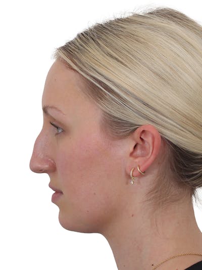Rhinoplasty Before & After Gallery - Patient 199292 - Image 1
