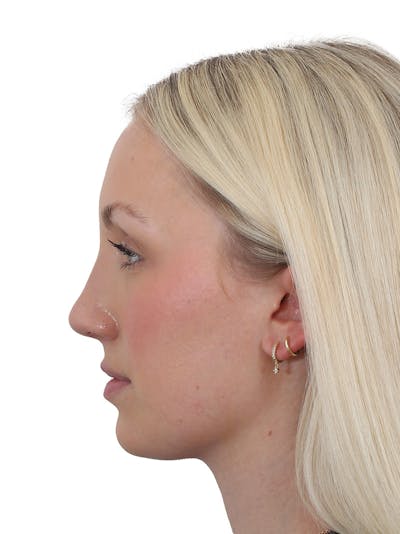 Rhinoplasty Before & After Gallery - Patient 199292 - Image 2