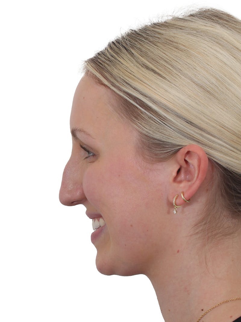 Rhinoplasty Before & After Gallery - Patient 199292 - Image 3