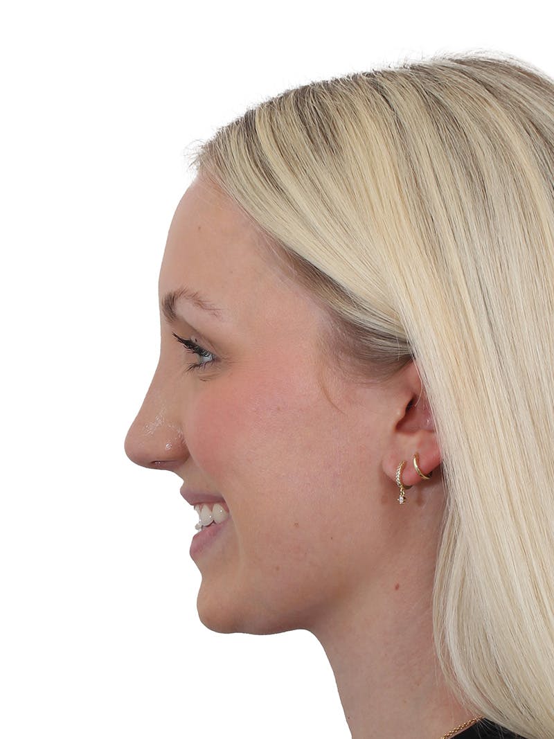 Rhinoplasty Before & After Gallery - Patient 199292 - Image 4