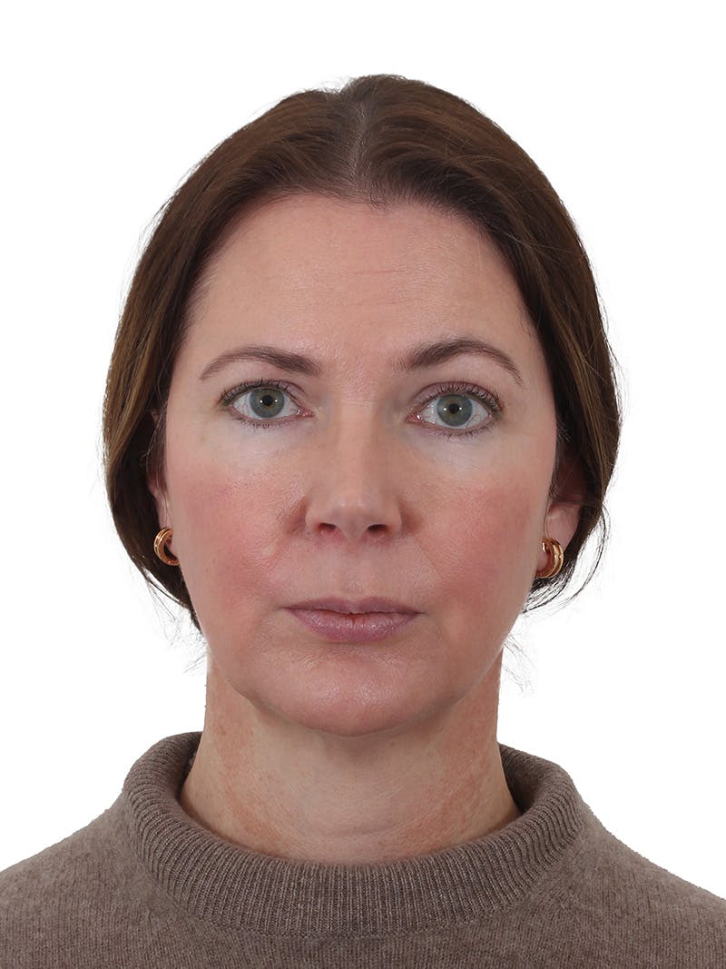 Facelift/Neck Lift Before & After Gallery - Patient 193098 - Image 3