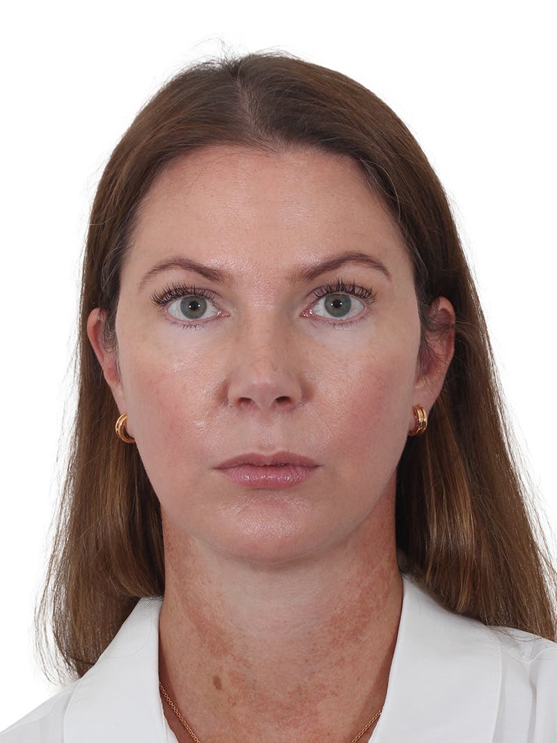 Facelift/Neck Lift Before & After Gallery - Patient 193098 - Image 4
