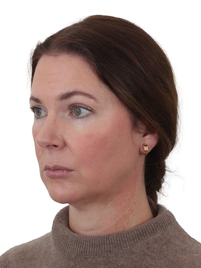 Facelift/Neck Lift Before & After Gallery - Patient 193098 - Image 1