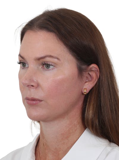 Facelift/Neck Lift Before & After Gallery - Patient 193098 - Image 2