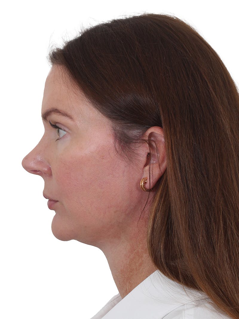Facelift/Neck Lift Before & After Gallery - Patient 193098 - Image 6