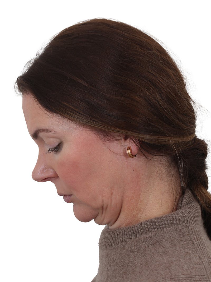 Facelift/Neck Lift Before & After Gallery - Patient 193098 - Image 7