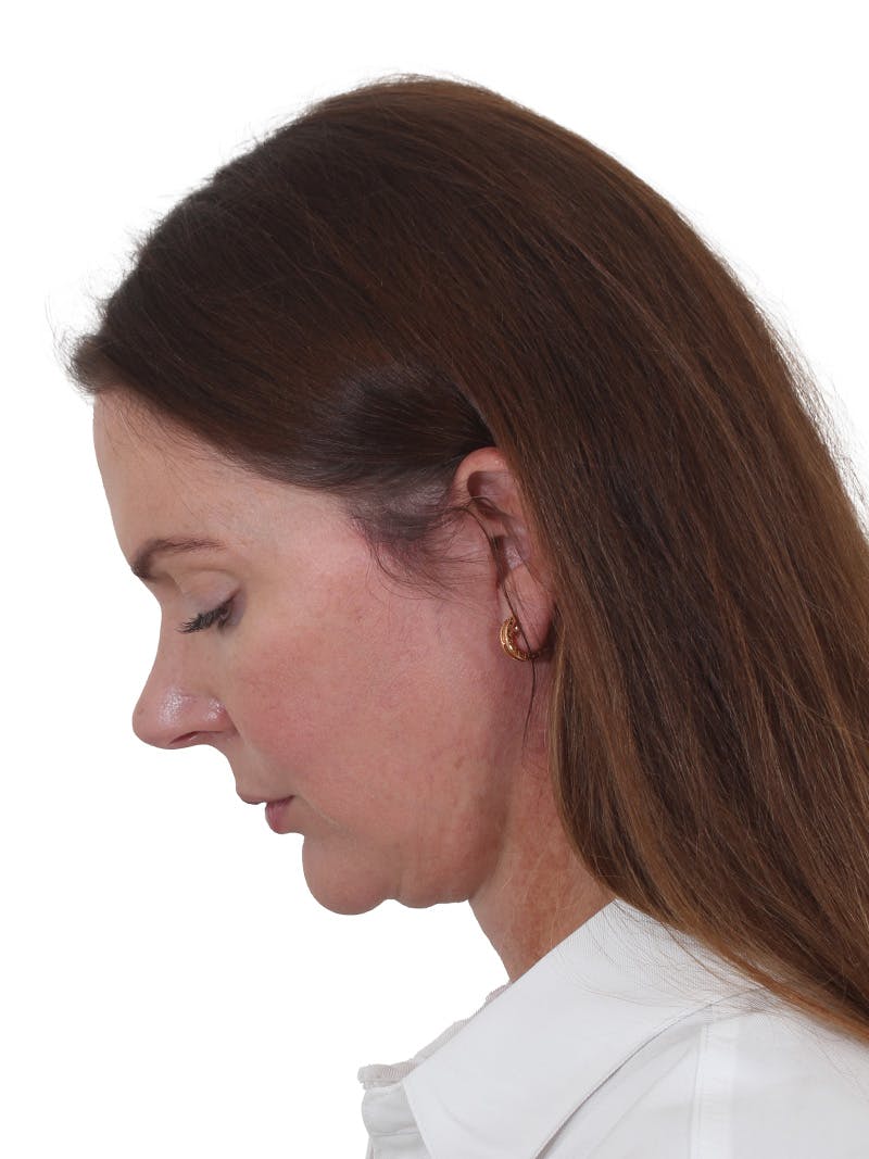Facelift/Neck Lift Before & After Gallery - Patient 193098 - Image 8