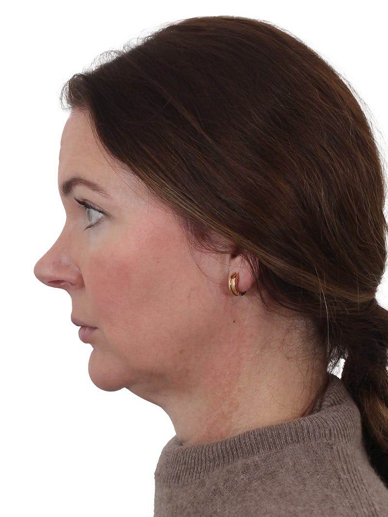 Facelift/Neck Lift Before & After Gallery - Patient 193098 - Image 5