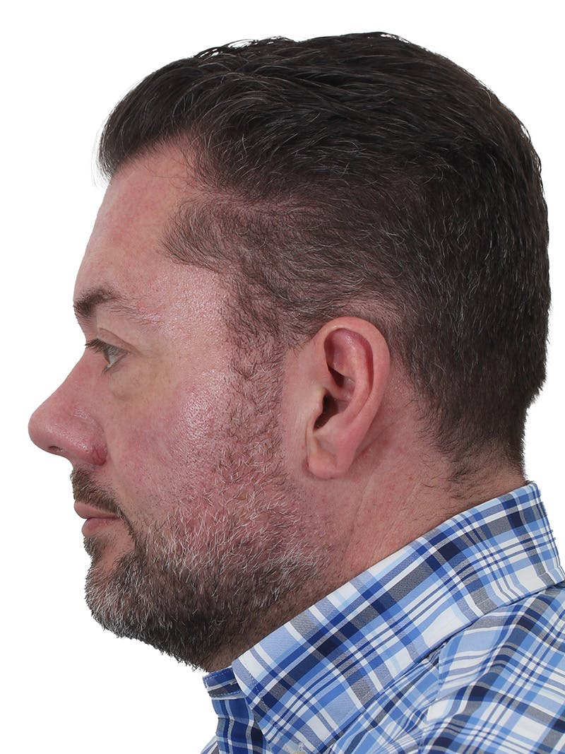 Fat Transfer Before & After Gallery - Patient 735182 - Image 7