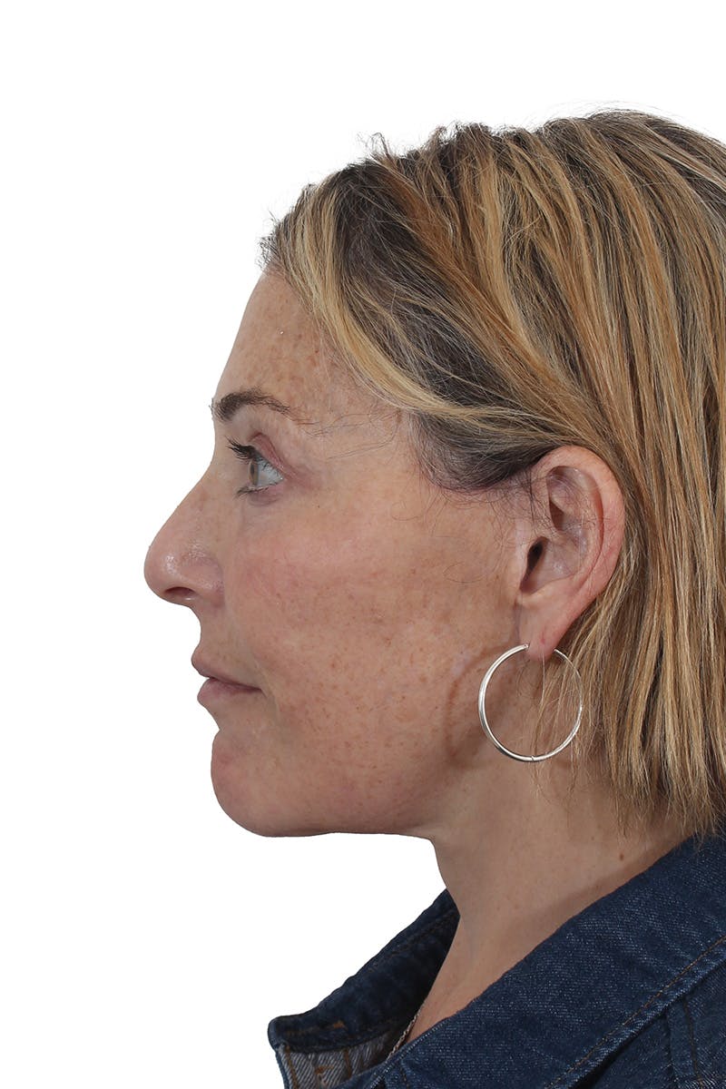 Facelift/Neck Lift Before & After Gallery - Patient 148519701 - Image 4