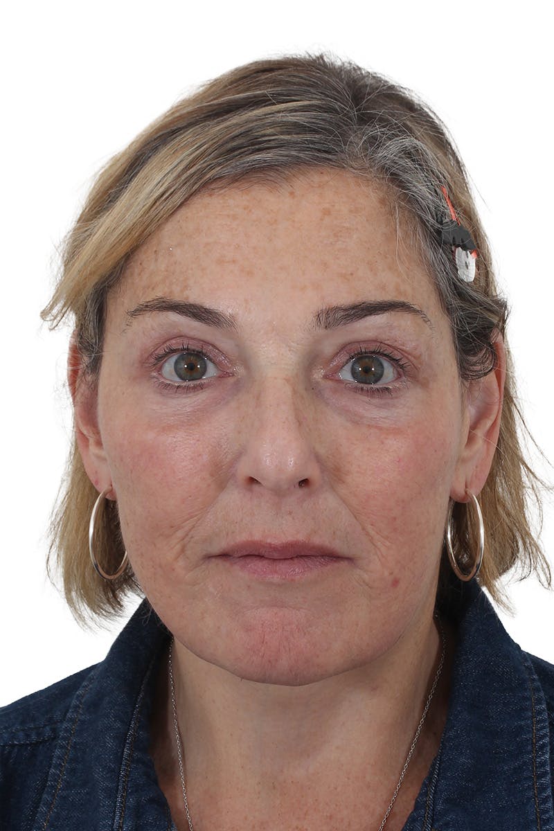 Facelift/Neck Lift Before & After Gallery - Patient 148519701 - Image 6
