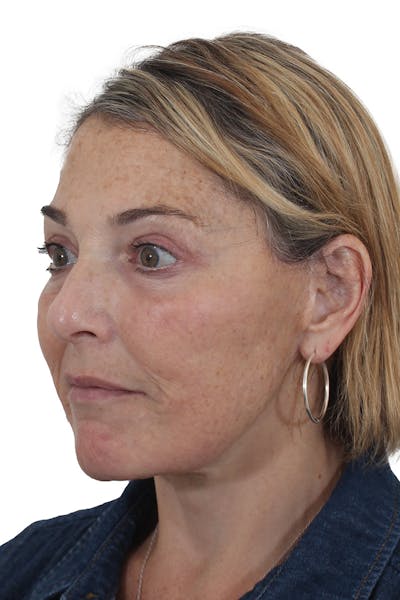 Facelift/Neck Lift Before & After Gallery - Patient 148519701 - Image 2