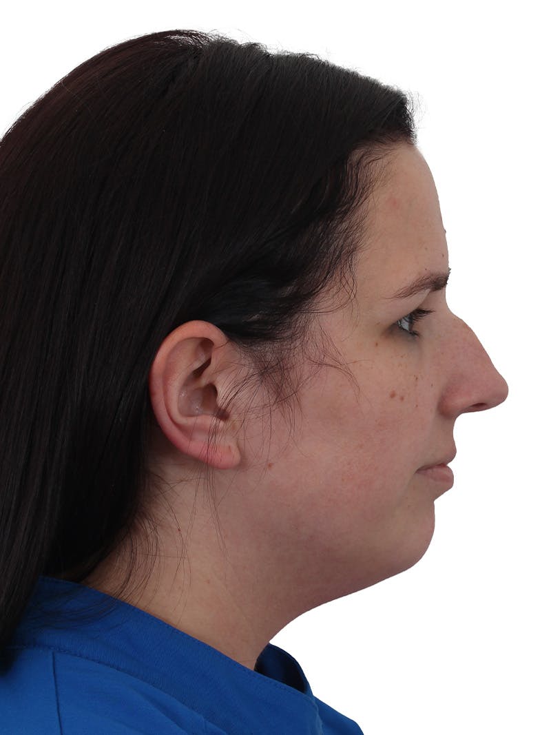 Chin Augmentation Before & After Gallery - Patient 165640 - Image 7
