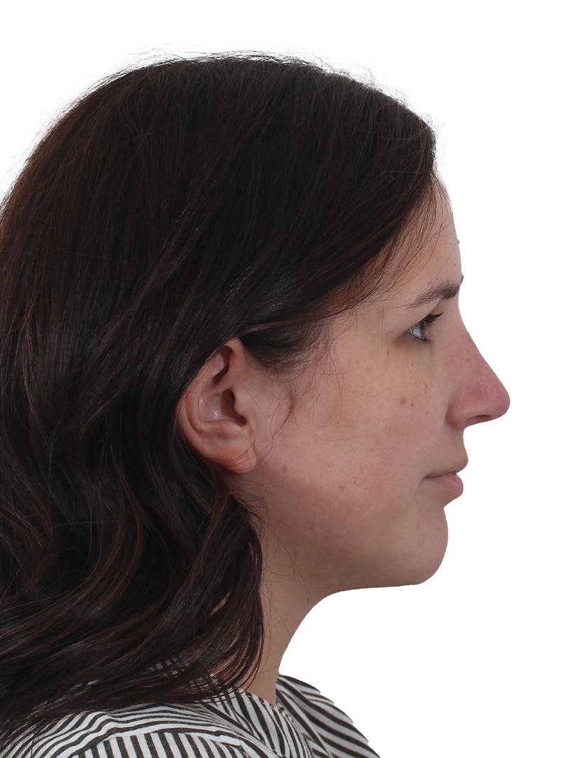 Chin Augmentation Before & After Gallery - Patient 165640 - Image 8