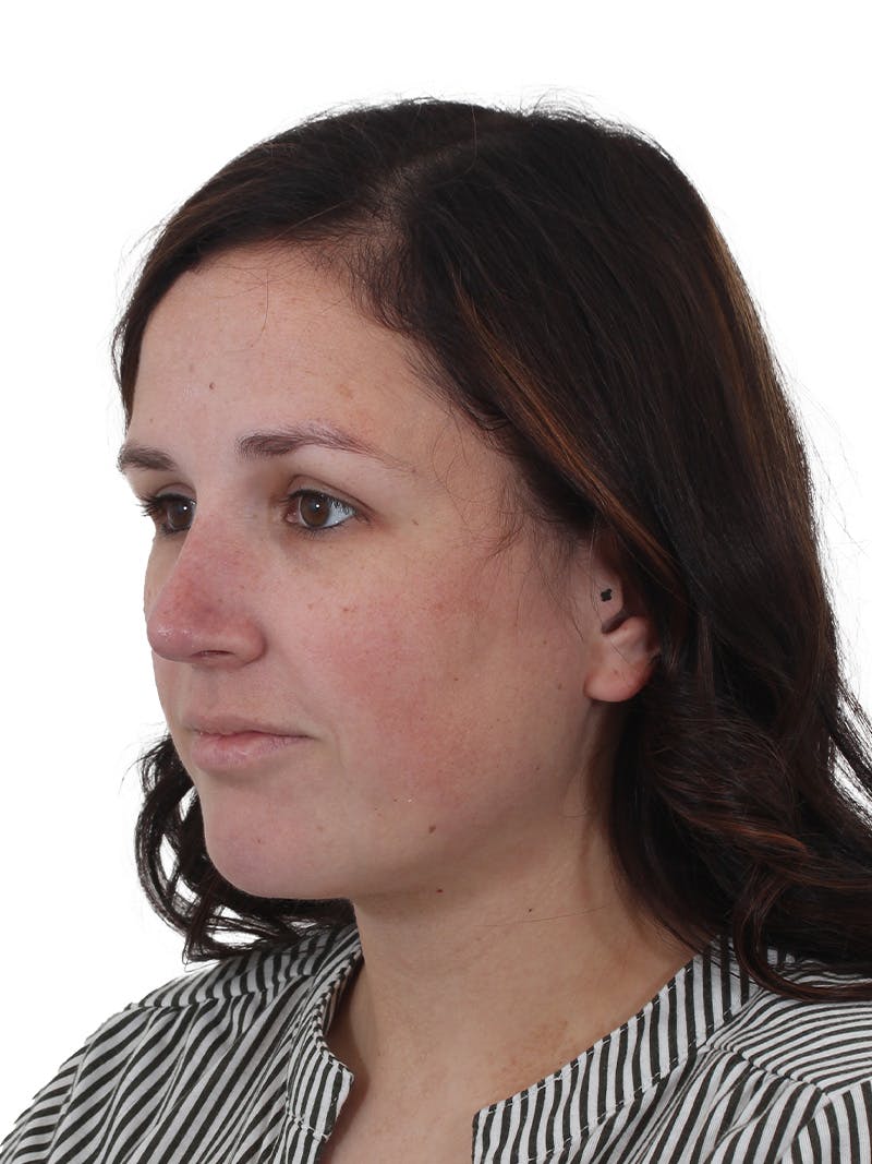 Chin Augmentation Before & After Gallery - Patient 165640 - Image 10