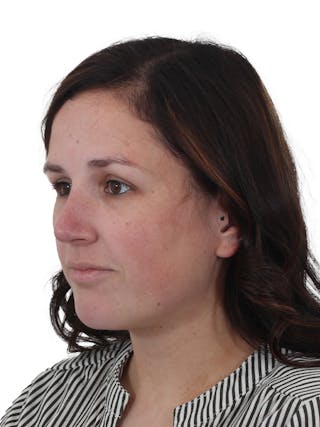 Rhinoplasty Before & After Gallery - Patient 334454 - Image 10