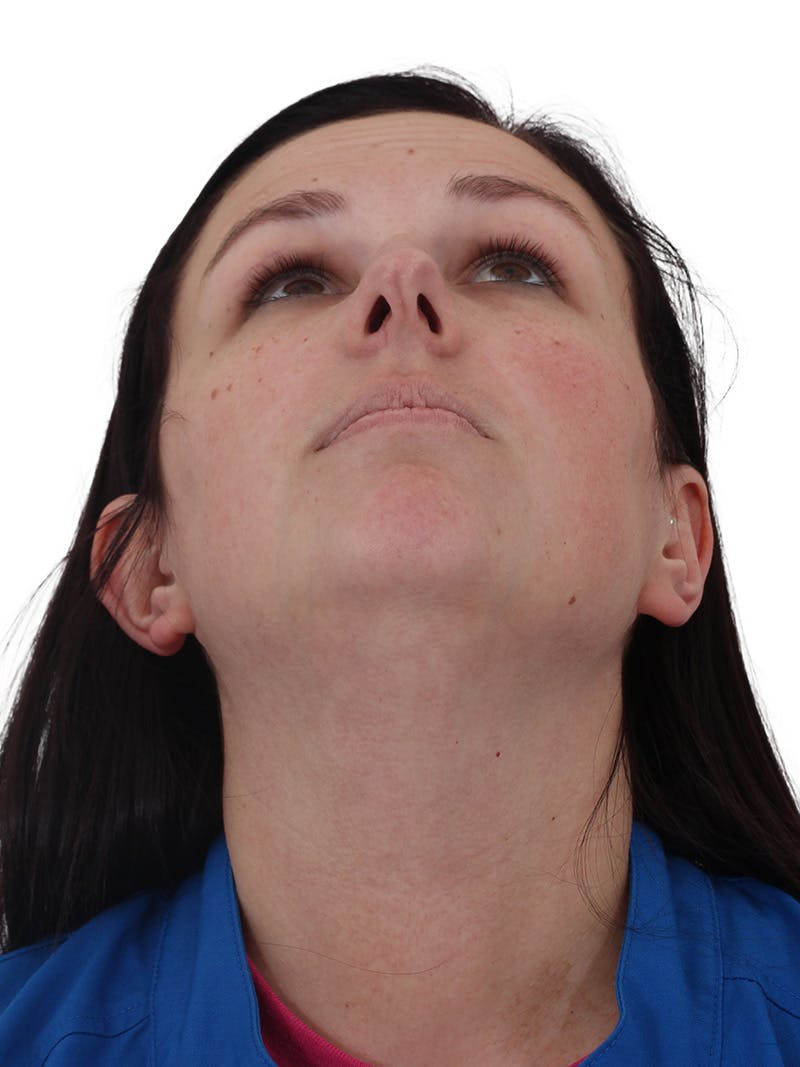 Chin Augmentation Before & After Gallery - Patient 165640 - Image 11