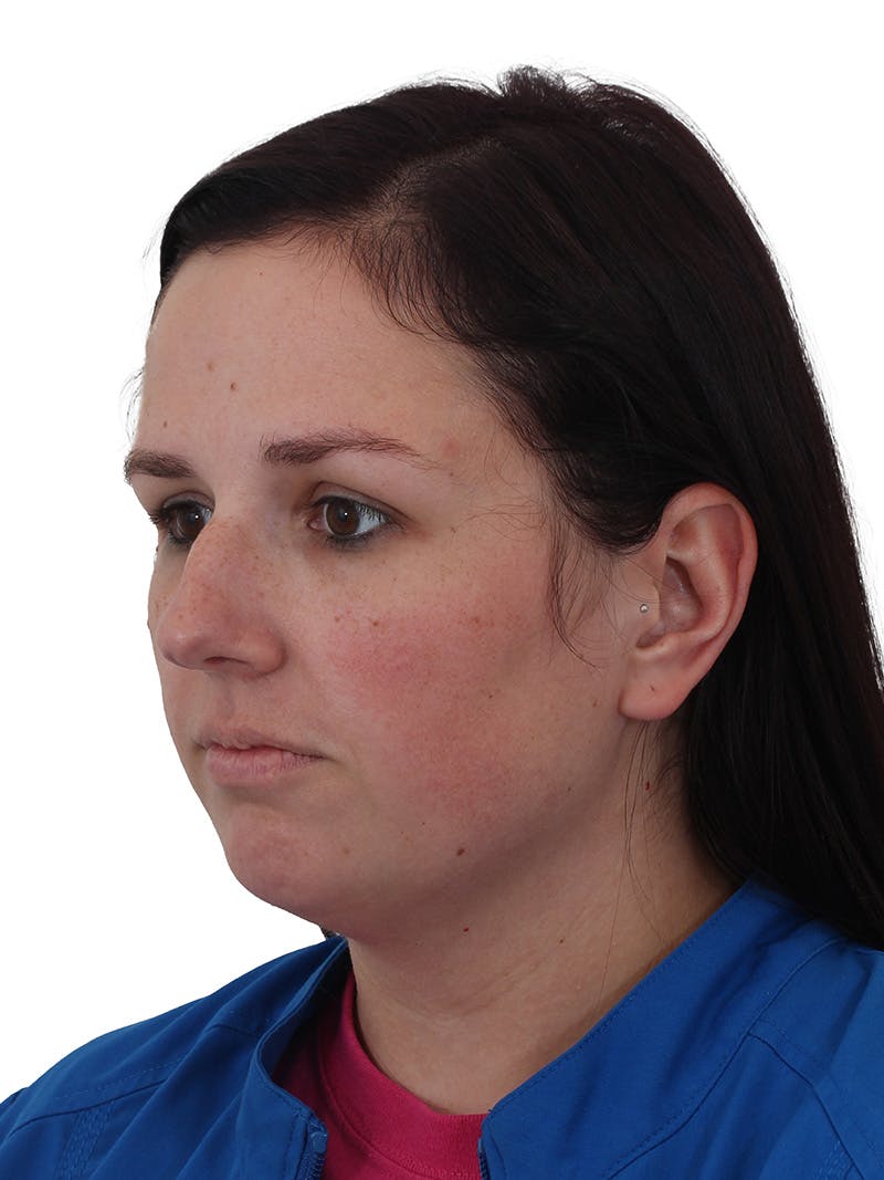 Chin Augmentation Before & After Gallery - Patient 165640 - Image 9