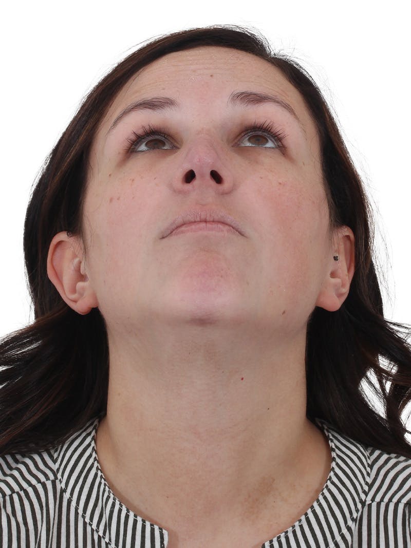 Chin Augmentation Before & After Gallery - Patient 165640 - Image 12