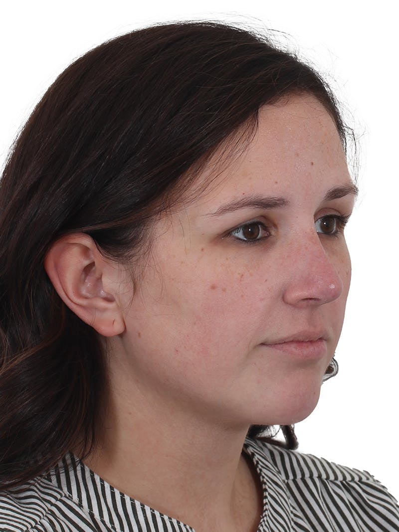 Chin Augmentation Before & After Gallery - Patient 165640 - Image 6