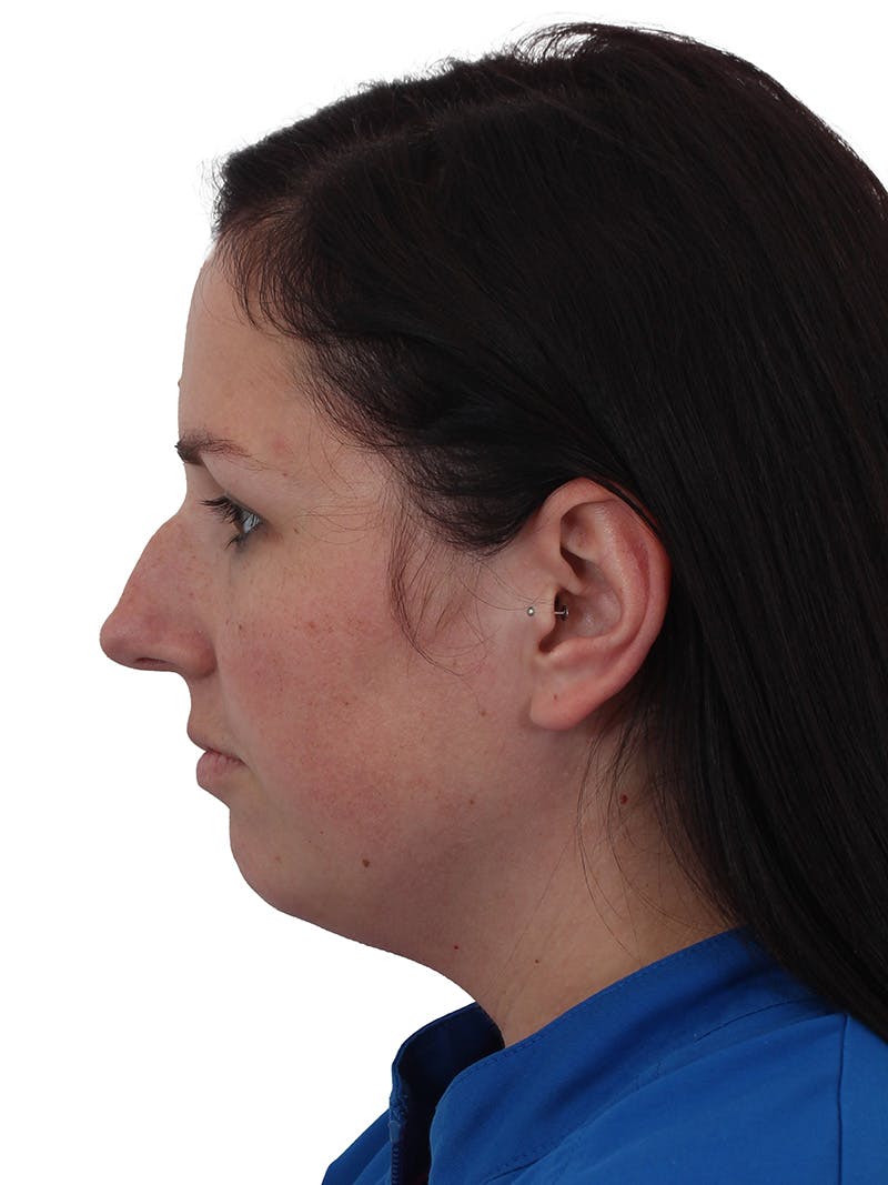 Chin Augmentation Before & After Gallery - Patient 165640 - Image 1