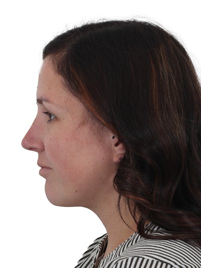 Chin Augmentation Before & After Gallery - Patient 165640 - Image 2