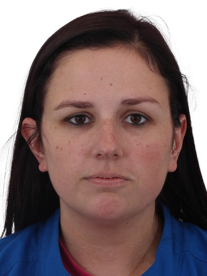Chin Augmentation Before & After Gallery - Patient 165640 - Image 3