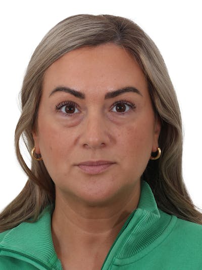 Blepharoplasty Before & After Gallery - Patient 406756 - Image 1
