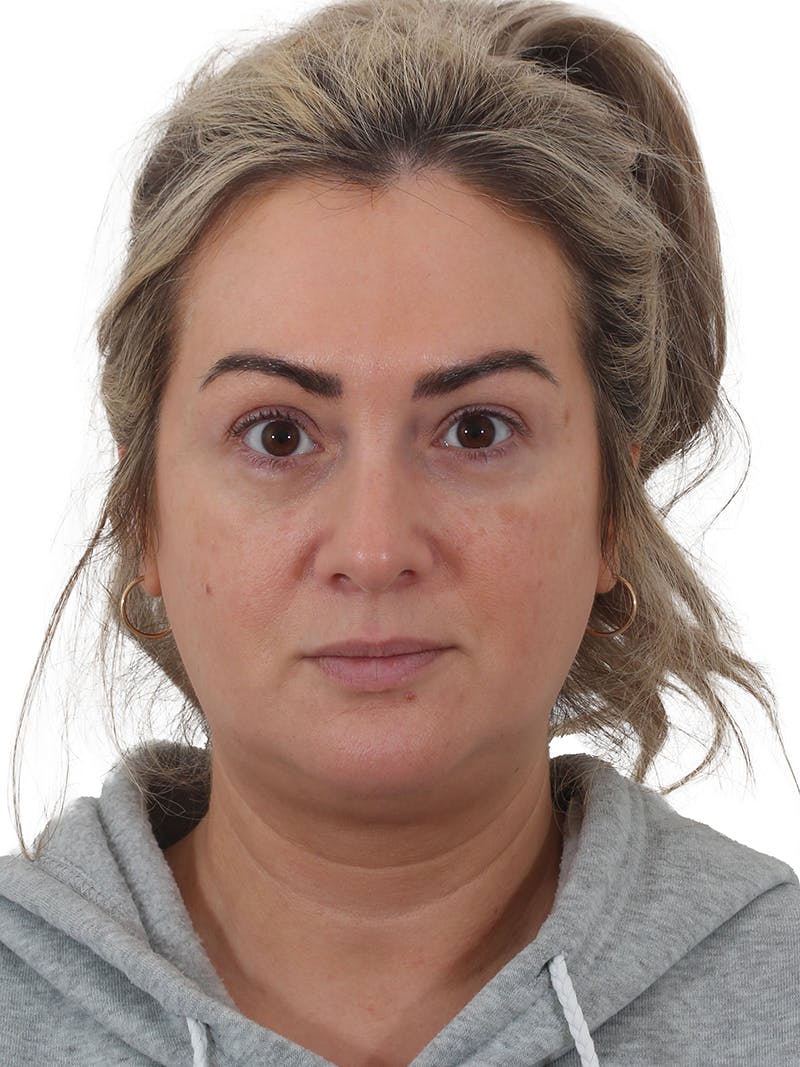 Blepharoplasty Before & After Gallery - Patient 406756 - Image 2