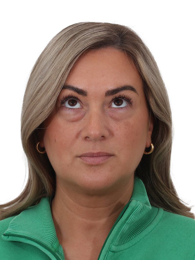 Blepharoplasty Before & After Gallery - Patient 406756 - Image 3
