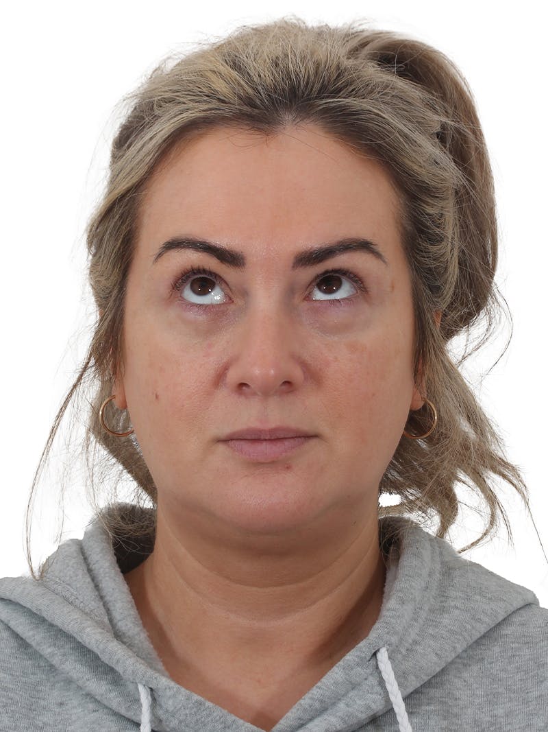 Blepharoplasty Before & After Gallery - Patient 406756 - Image 4