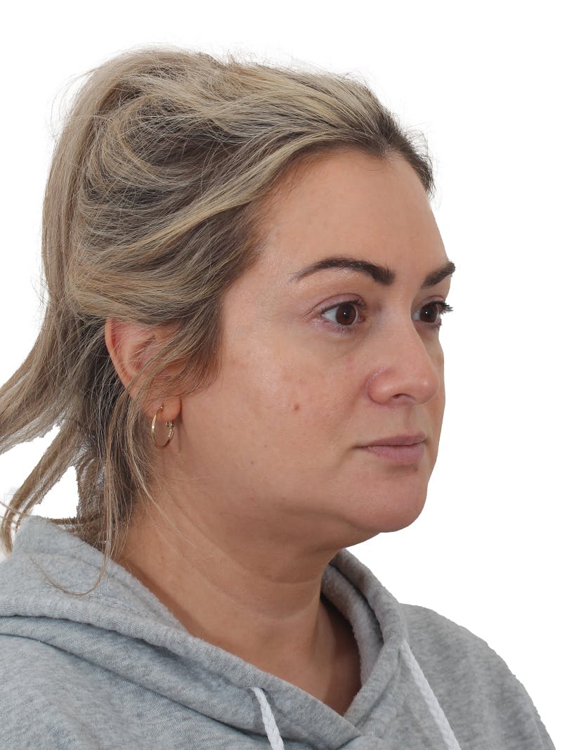 Blepharoplasty Before & After Gallery - Patient 406756 - Image 6