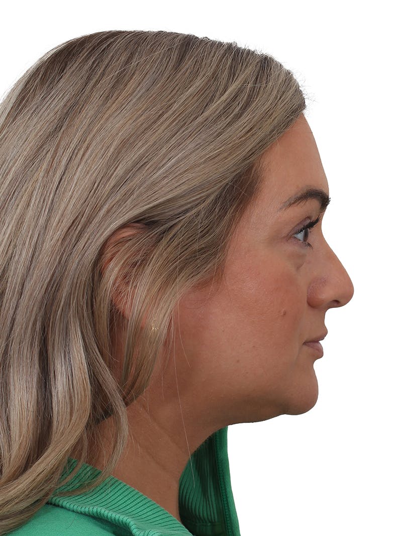 Blepharoplasty Before & After Gallery - Patient 406756 - Image 7
