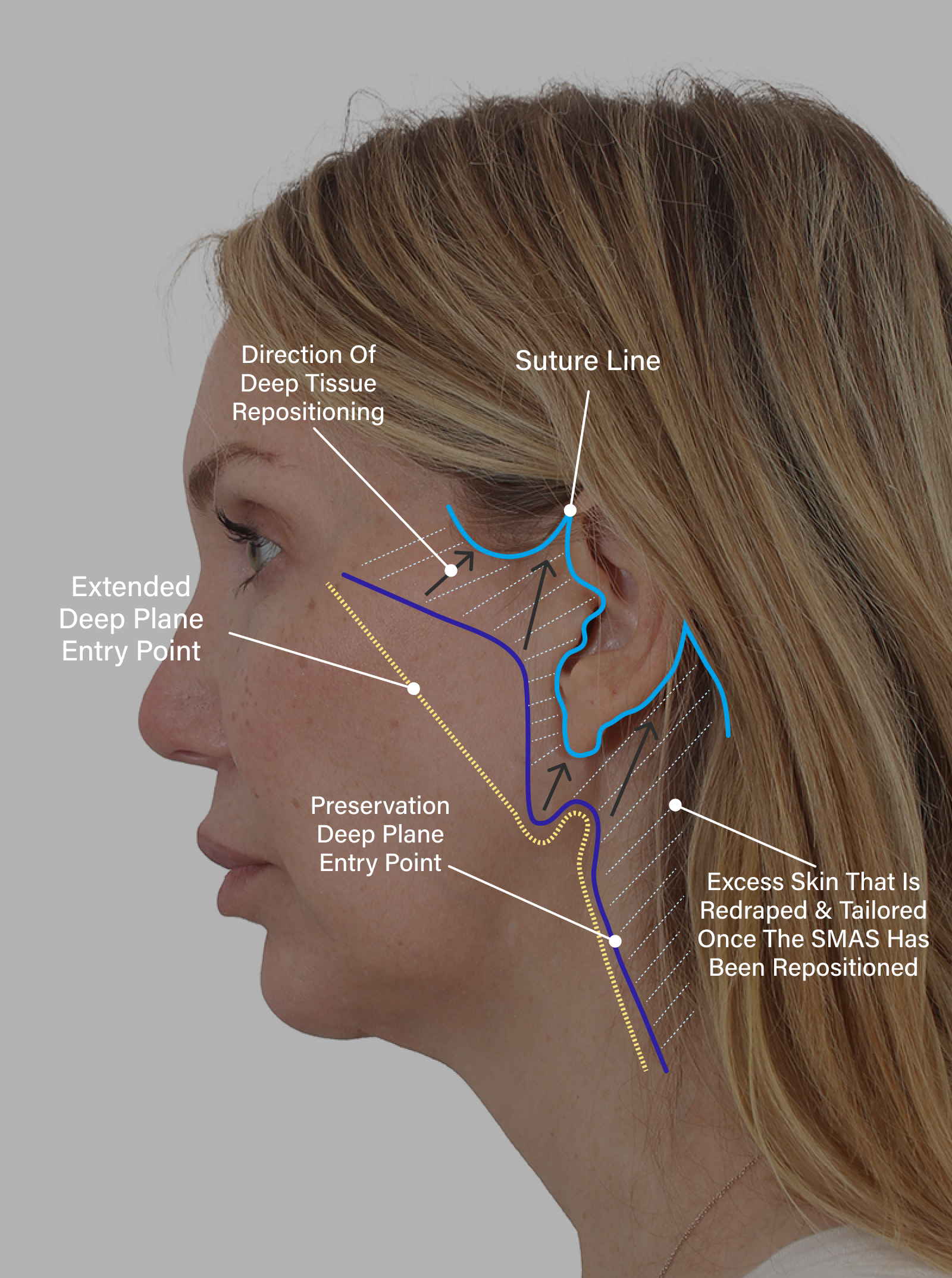 preservatino facelift diagram