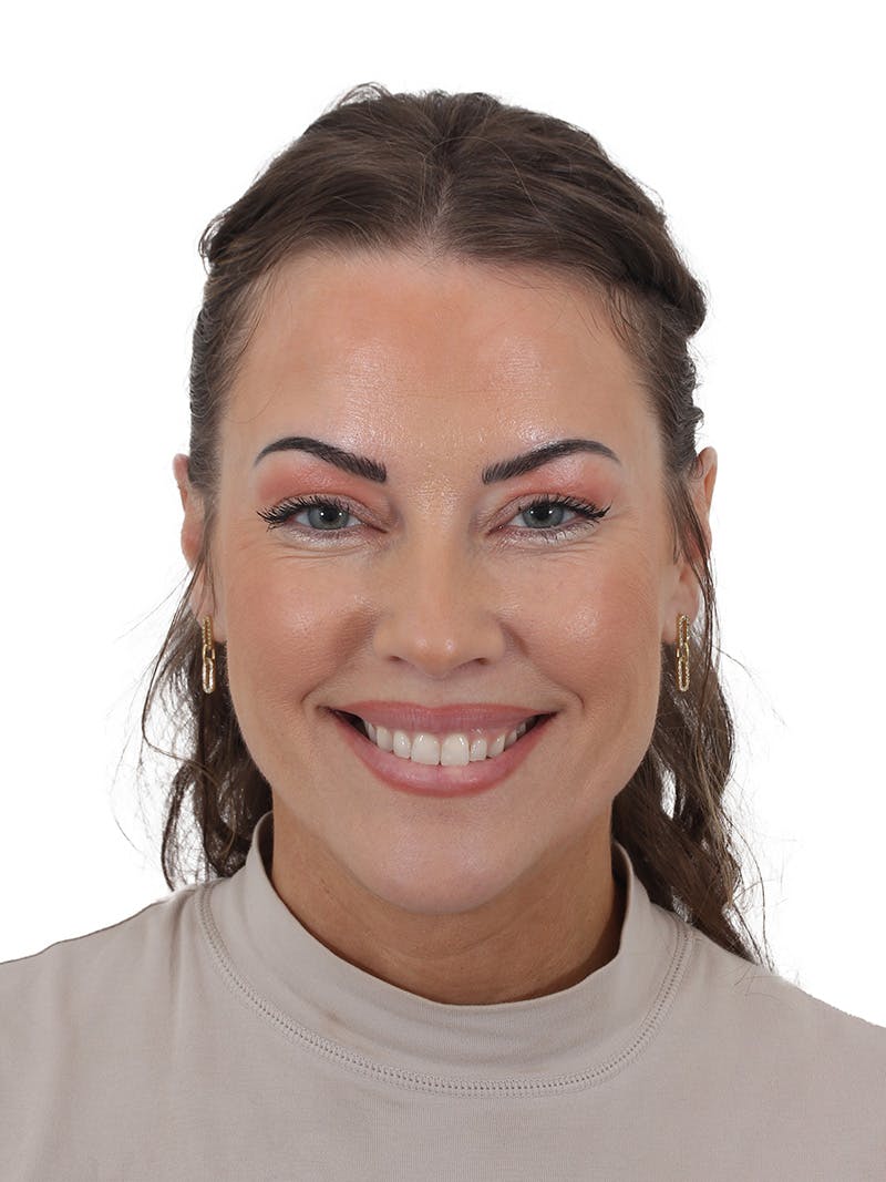 Laser Treatment Before & After Gallery - Patient 277460 - Image 1