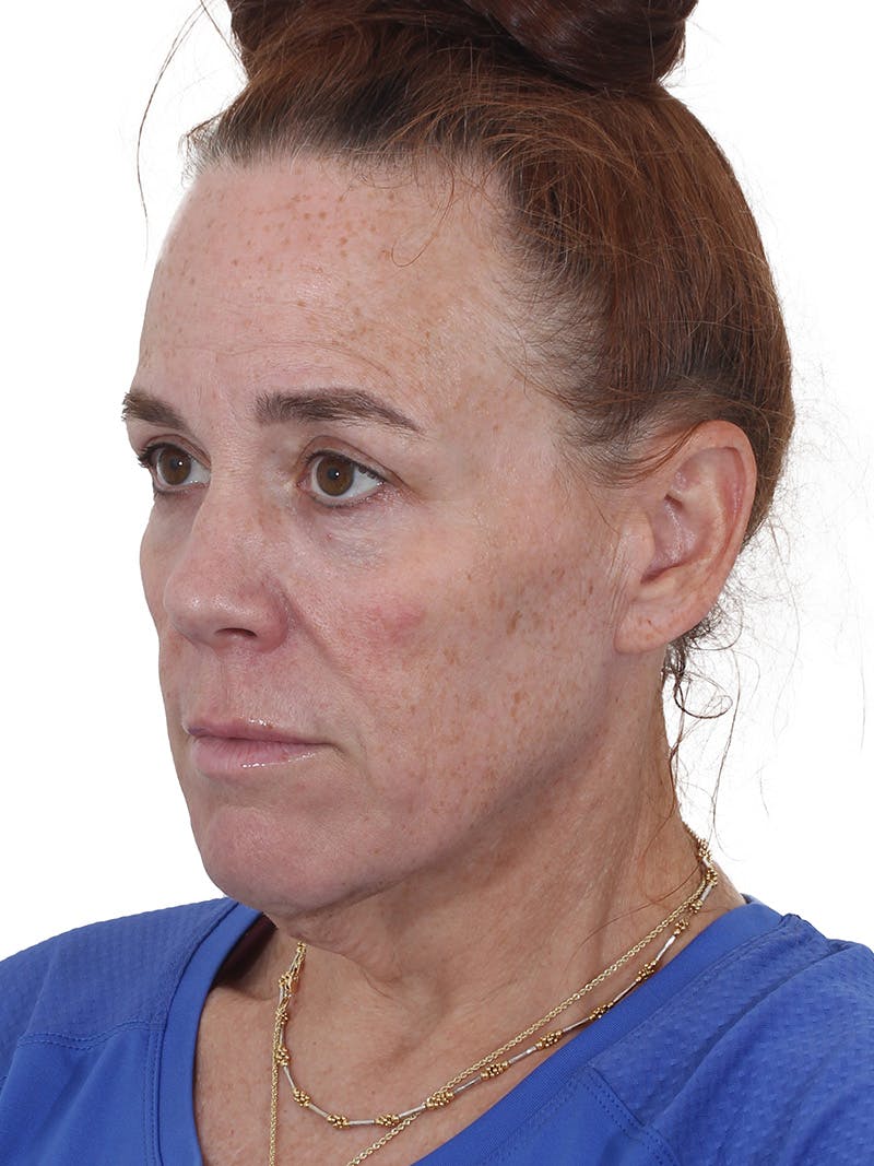 Laser Treatment Before & After Gallery - Patient 241742 - Image 5