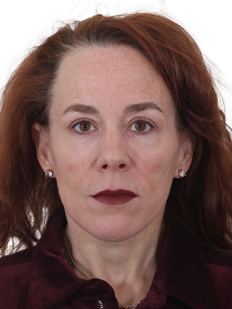 Laser Treatment Before & After Gallery - Patient 241742 - Image 8