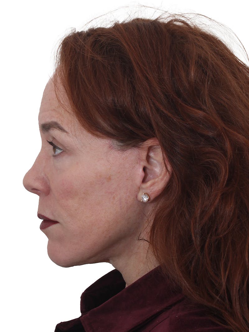 Dr. Frankel’s Facelift in Cleveland Before and After 03