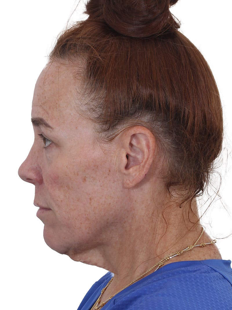 Dr. Frankel’s Facelift in Cleveland Before and After 03
